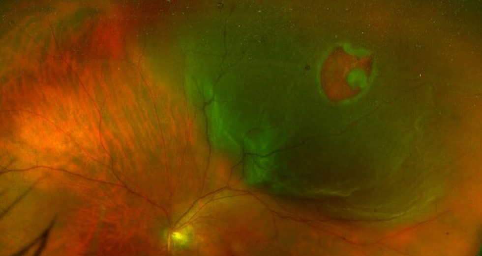 Rétinophotographie OPTOS grand champ montrant un décollement de rétine avec déchirure visible